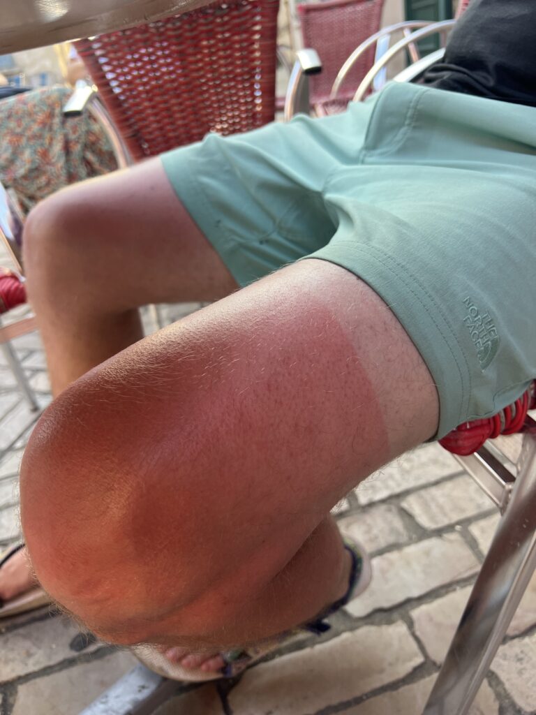 Sunburned legs.